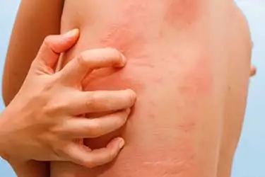 allergic skin reaction of hives and itching
