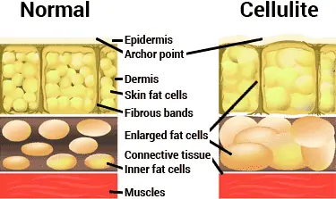 diagram of normal skin vs. cellulite