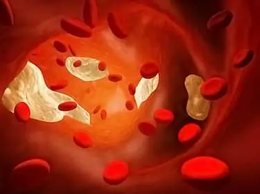 atherosclerosis inside artery
