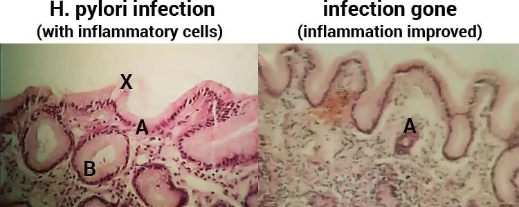 H. pylori infection before and after licorice treatment