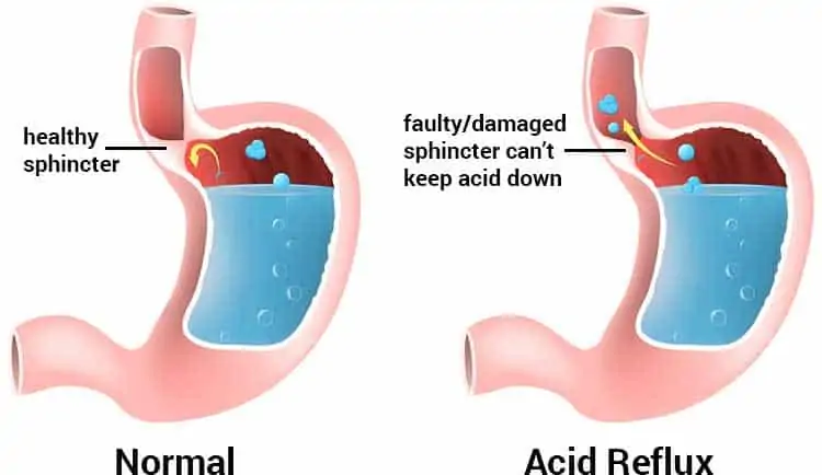 diagram of acid reflux vs. healthy sphincter