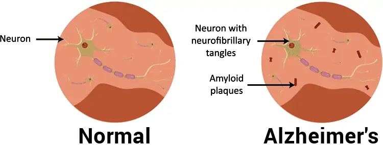 amyloid plaques and neurofibrillary tangles in Alzheimer's disease