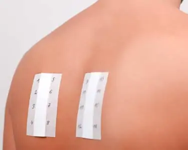person's back with skin prick allergy test